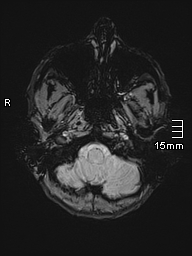 Basilar artery perforator aneurysm (Radiopaedia 82455-99523 Axial SWI 6).jpg