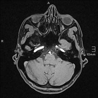 Basilar artery perforator aneurysm (Radiopaedia 82455-99523 F 23).jpg
