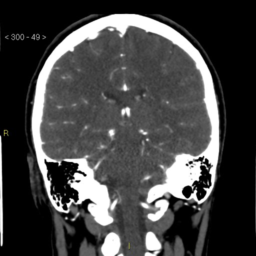 File:Basilar artery thrombosis (Radiopaedia 16260-15944 B 40).jpg