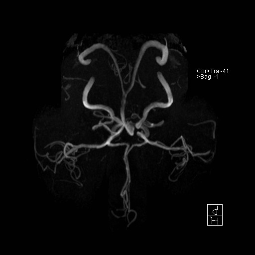 Basilar tip aneurysm (Radiopaedia 26504-26632 D 17).jpg