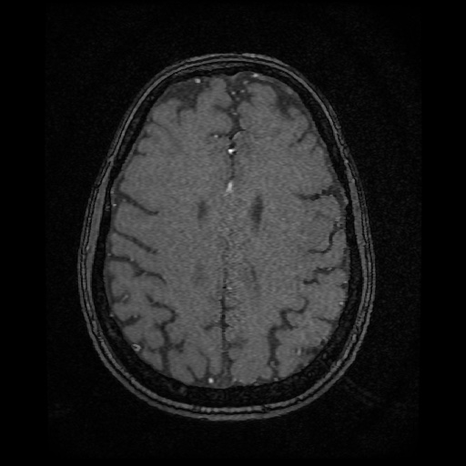 Basilar top and left middle cerebral artery aneurysm (Radiopaedia 61965-70031 Axial MRA 122).jpg
