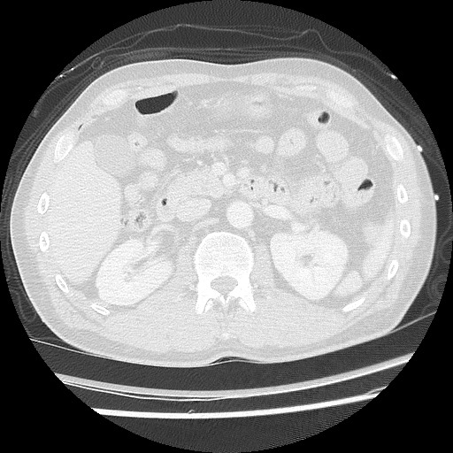 Benign post-traumatic pseudopneumoperitoneum (Radiopaedia 71199-81495 Axial lung window 79).jpg