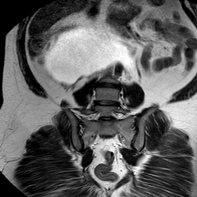 File:Benign seromucinous cystadenoma of the ovary (Radiopaedia 71065-81300 F 23).jpg