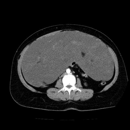 Benign spindle cell tumor - abdominopelvic (Radiopaedia 61300-69212 A 33).jpg