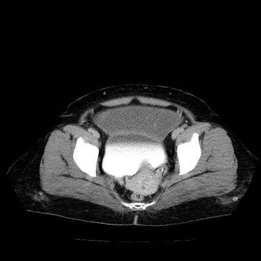 Benign spindle cell tumor - abdominopelvic (Radiopaedia 61300-69212 Axial C+ delayed 54).jpg
