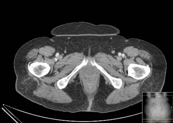 Bicameral celiacomesenteric aneurysm (Radiopaedia 55766-62327 A 78).jpg