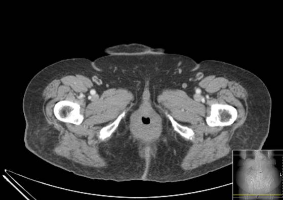Bicameral celiacomesenteric aneurysm (Radiopaedia 55766-62327 A 81).jpg