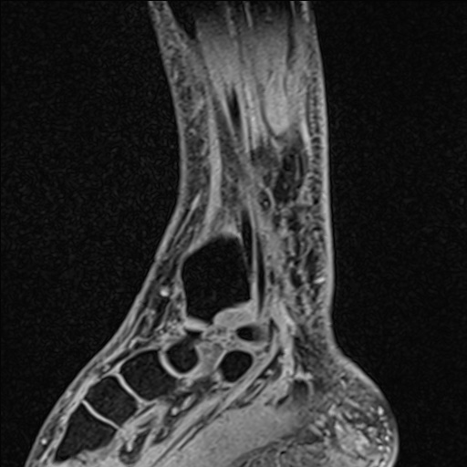 File:Bilateral Achilles tendon complete tear (Radiopaedia 81344-95051 Sagittal WE - Right 78).jpg