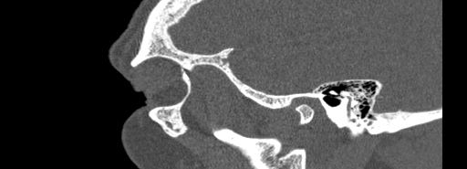 Bilateral Ectopic Infraorbital Nerves (Radiopaedia 49006-54084 Sagittal bone window 53).jpg