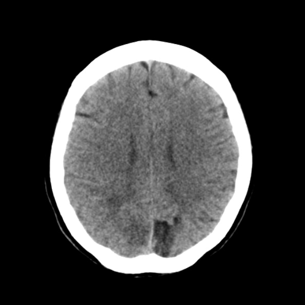 File:Bilateral PCA territory infarction - different ages (Radiopaedia 46200-50591 Axial non-contrast 15).jpg