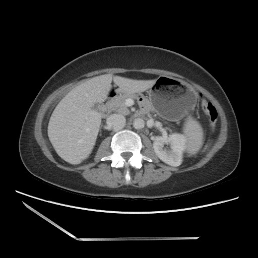 File:Bilateral adrenal granulocytic sarcomas (chloromas) (Radiopaedia 78375-91007 A 50).jpg