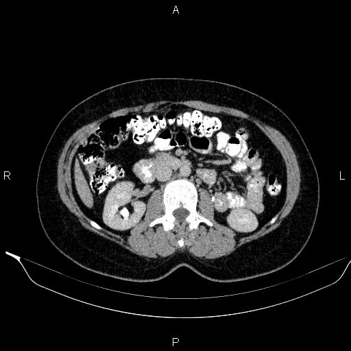 Bilateral adrenal myelolipoma (Radiopaedia 63058-71535 Axial C+ delayed 59).jpg