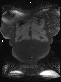 Bilateral adrenal myelolipoma (Radiopaedia 63058-71537 Coronal T1 fat sat 102).jpg