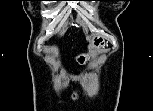 Bilateral benign adrenal adenomas (Radiopaedia 86912-103124 D 3).jpg