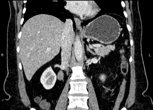 Bilateral benign adrenal adenomas (Radiopaedia 86912-103124 D 34).jpg