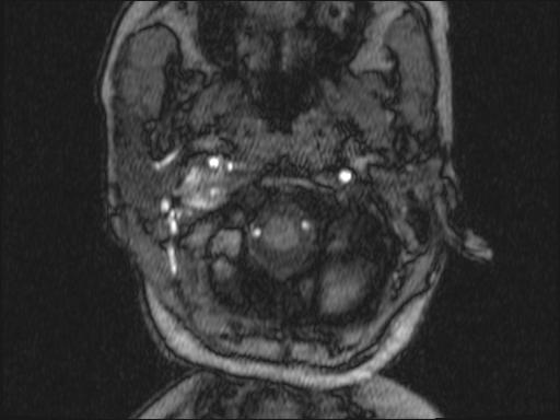 Bilateral carotid body tumors and right glomus jugulare tumor (Radiopaedia 20024-20060 Axial MRA 298).jpg