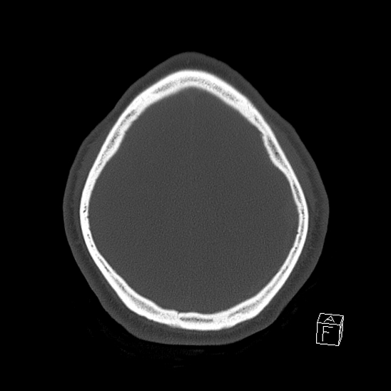 Bilateral occipital condyle fracture (type 2) (Radiopaedia 87675-104089 Axial bone window 112).jpg