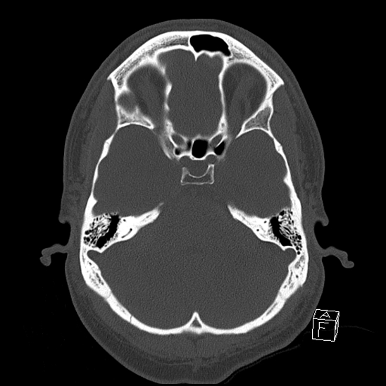 File:Bilateral occipital condyle fracture (type 2) (Radiopaedia 87675-104089 Axial bone window 37).jpg