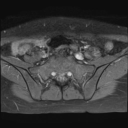 File:Bilateral ovarian endometriomas (Radiopaedia 87085-103347 Axial T1 C+ fat sat 2).jpg