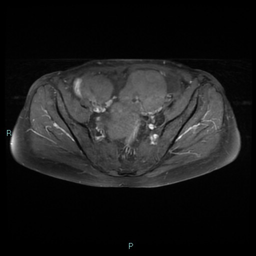 File:Bilateral ovarian fibroma (Radiopaedia 44568-48293 Axial T1 C+ fat sat 11).jpg