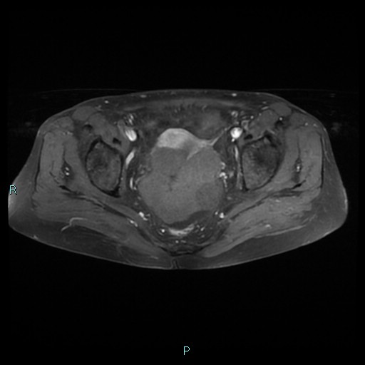 File:Bilateral ovarian fibroma (Radiopaedia 44568-48293 Axial T1 C+ fat sat 17).jpg