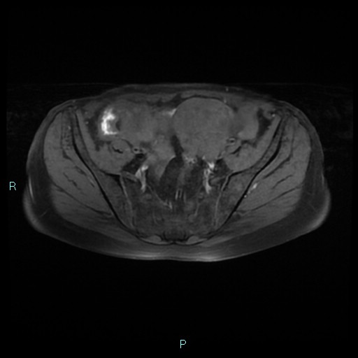 File:Bilateral ovarian fibroma (Radiopaedia 44568-48293 Axial T1 fat sat 9).jpg