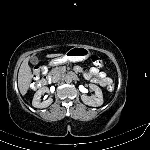 Bilateral ovarian serous cystadenocarcinoma (Radiopaedia 86062-101989 Axial C+ delayed 21).jpg