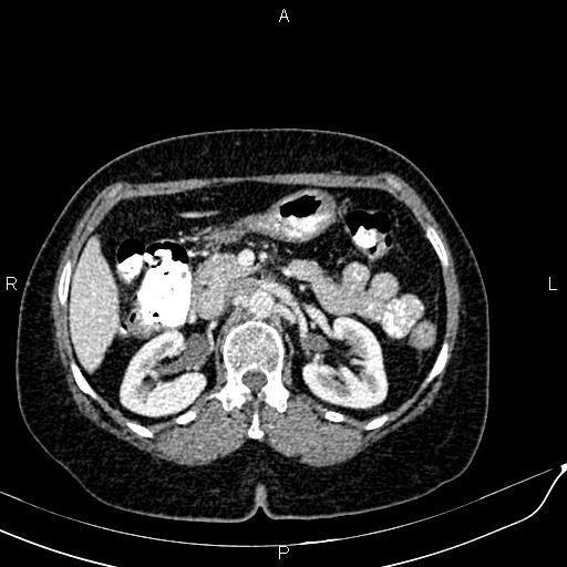 Bilateral ovarian serous cystadenocarcinoma (Radiopaedia 86062-101989 B 37).jpg