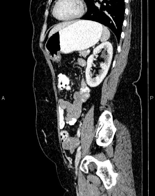 Bilateral ovarian serous cystadenocarcinoma (Radiopaedia 86062-101989 E 61).jpg