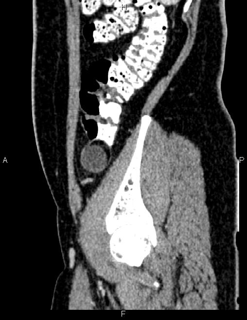 Bilateral ovarian teratoma (Radiopaedia 83131-97503 D 34).jpg