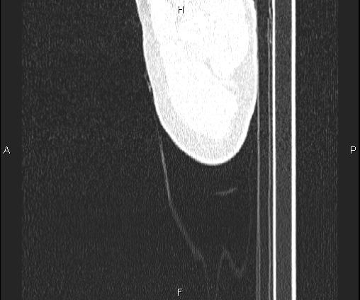 File:Bilateral pulmonary AVM (Radiopaedia 83134-97505 Sagittal lung window 1).jpg
