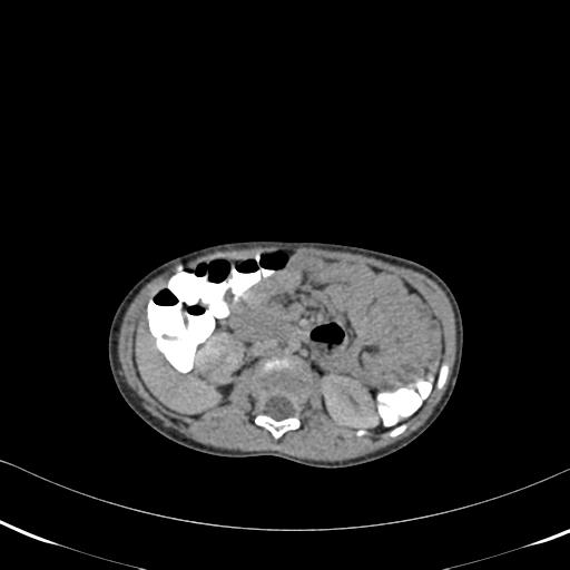 File:Bilateral renal malrotation (Radiopaedia 30901-31606 A 7).jpg