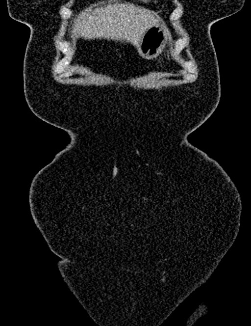 Bilateral staghorn calculi (Radiopaedia 59475-66842 Coronal non-contrast 33).jpg