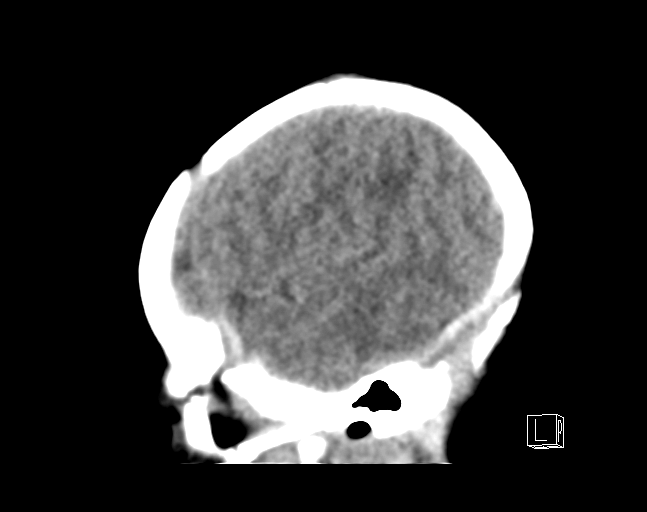 File:Bilateral subdural hemorrhage and parietal skull fracture (Radiopaedia 26058-26192 C 20).png
