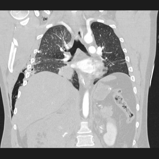 Bilateral traumatic renovascular injury (Radiopaedia 32051-32995 Coronal lung window 46).jpg