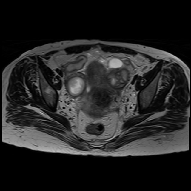 Bilateral tubo-ovarian abscesses (Radiopaedia 58635-65829 Axial T2 24).jpg