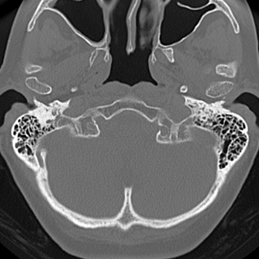 File:Bilateral tympanoplasty (Radiopaedia 16947-16664 Axial bone window 26).jpg