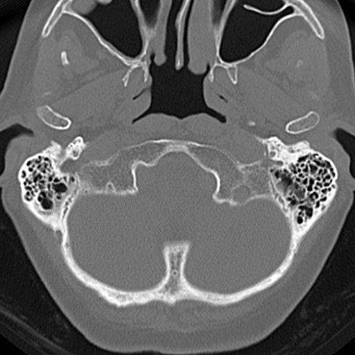 File:Bilateral tympanoplasty (Radiopaedia 16947-16664 Axial bone window 29).jpg