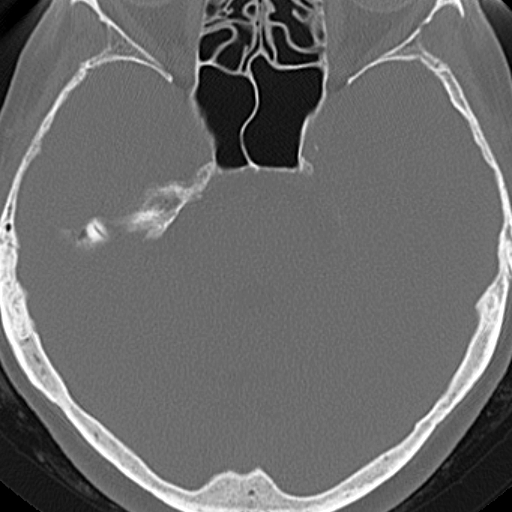 File:Bilateral tympanoplasty (Radiopaedia 16947-16664 Axial bone window 3).jpg