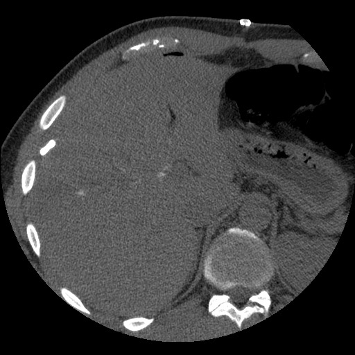 Bile leak from liver traumatic laceration (Radiopaedia 63463-72077 Axial Biliscopin 30).jpg