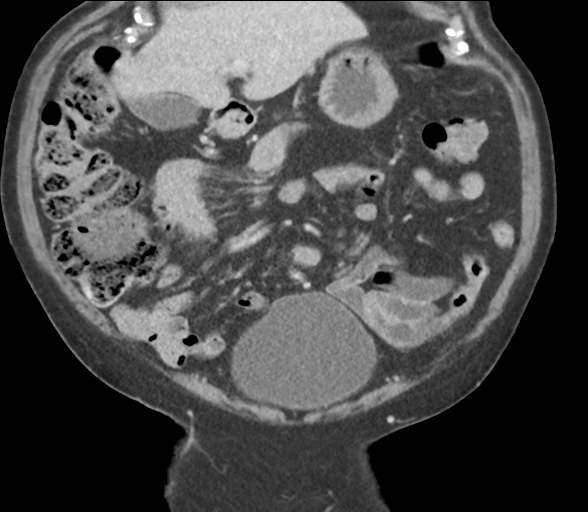 Bladder papillary urothelial carcinoma (Radiopaedia 48119-52951 C 24).png