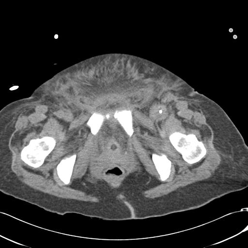 Bladder rupture post renal biopsy (Radiopaedia 30863-31572 Axial non-contrast 87).jpg