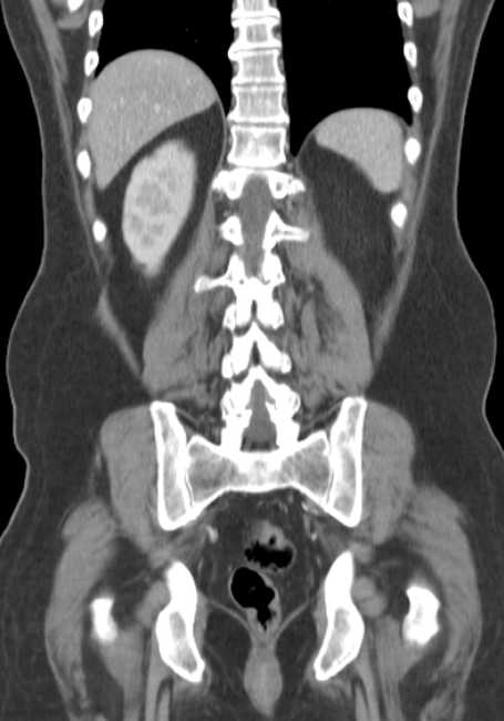 Bleeding duodenal ulcer and adenomyomatosis of gallbladder (Radiopaedia 61834-69861 B 21).jpg