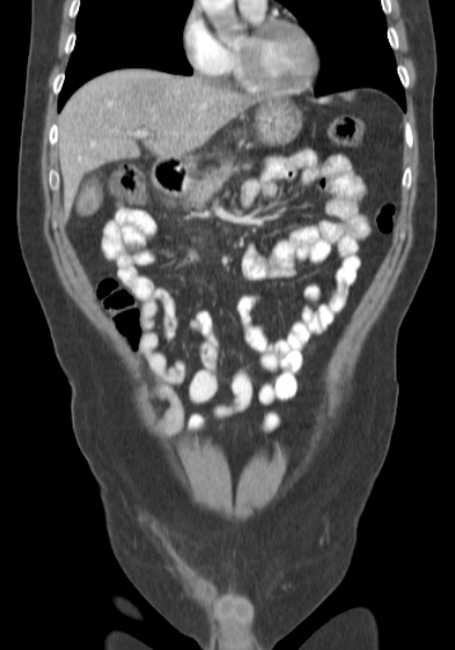 Bleeding duodenal ulcer and adenomyomatosis of gallbladder (Radiopaedia 61834-69861 B 60).jpg