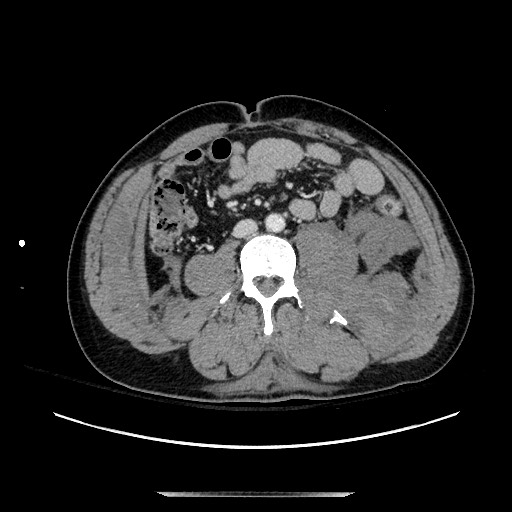 Blunt abdominal trauma with solid organ and musculoskelatal injury with active extravasation (Radiopaedia 68364-77895 A 85).jpg