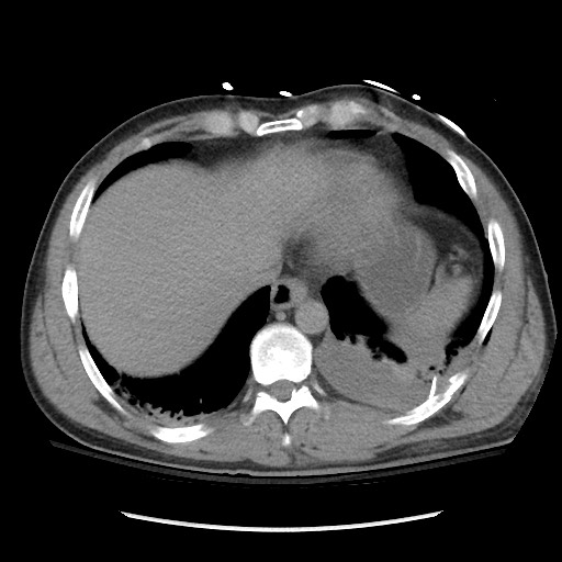 Blunt abdominal trauma with solid organ and musculoskelatal injury with active extravasation (Radiopaedia 68364-77895 Axial C+ delayed 18).jpg