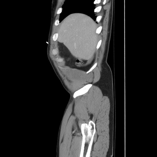 File:Blunt abdominal trauma with solid organ and musculoskelatal injury with active extravasation (Radiopaedia 68364-77895 C 29).jpg