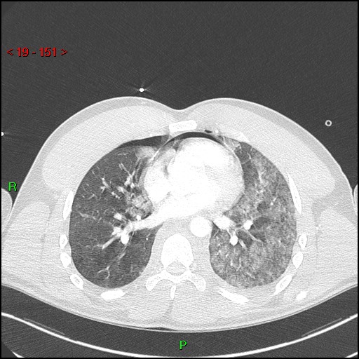 Blunt thoracic trauma (Radiopaedia 73454-84221 Axial lung window 55).jpg
