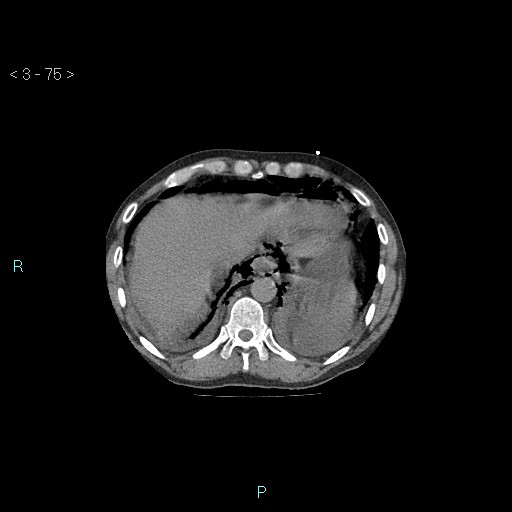 Boerhaave syndrome (Radiopaedia 27683-27897 Axial non-contrast 75).jpg