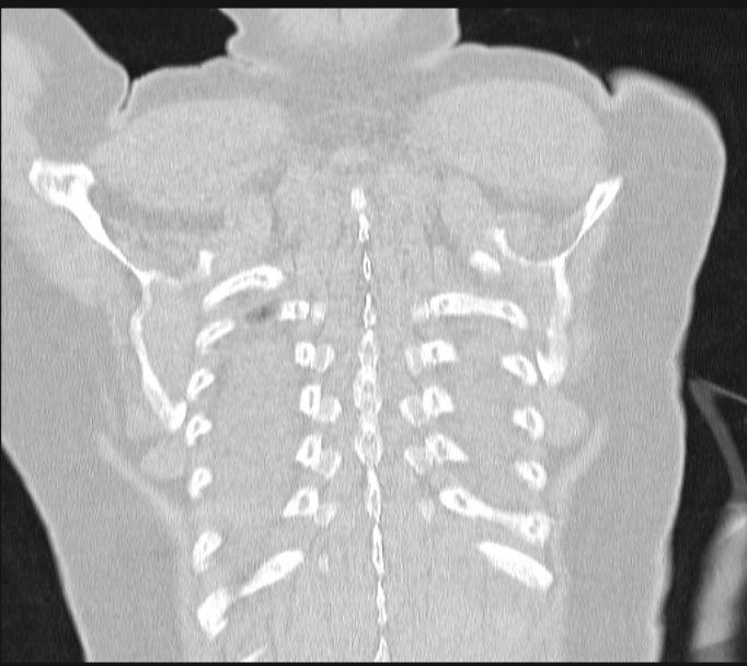 Boerhaave syndrome (Radiopaedia 45644-49799 Coronal lung window 63).jpg